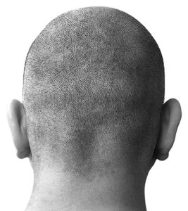 hair transplant in Budapest