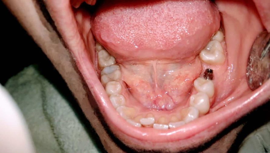 fog implantátum